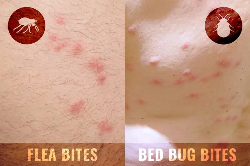 flea bites vs bed bug bites
