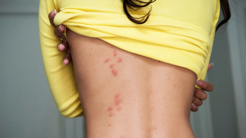 what can i put on my body to prevent bed bug bites