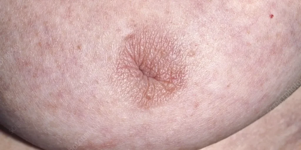 pictures of inverted nipples due to breast cancer